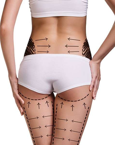 The Cost of Liposuction in Riyadh: Exploring Your Financial Options