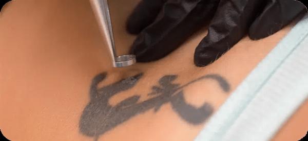 Laser Tattoo Removal: Transform Your Look Effortlessly
