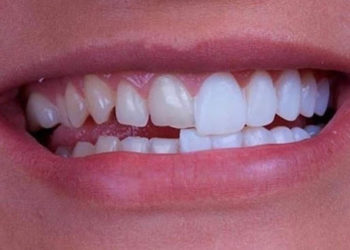 E-Max Veneers in Riyadh: Revolutionize Your Smile with Cutting-Edge Technology