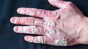 Everything You Need to Know About Psoriasis