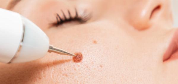 Your Complete Guide to Skin Tag Removal Treatment: Get Smooth Skin Today