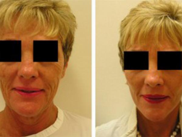 How Facelift Surgery Can Transform Your Appearance and Confidence