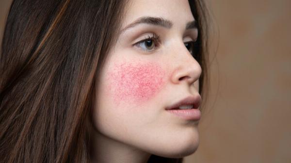 Rosacea Treatment Restore Your Confidence