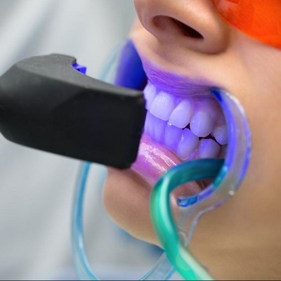 Home Teeth Whitening for Special Occasions: Dubai's Best Practices