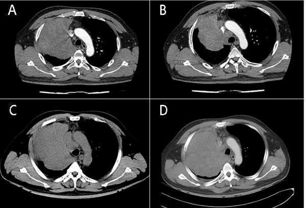 NUT Midline Carcinoma Treatment Market: Unveiling Competition, Size, and Robust Growth Prospects Through 2029