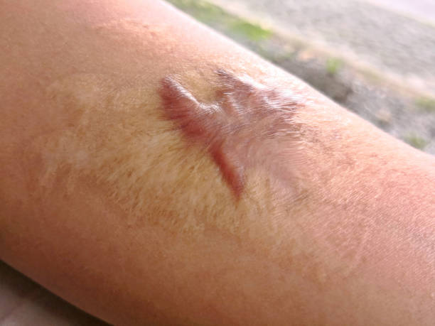 Your Journey to Recovery: Burn Reconstruction Surgery in Riyadh