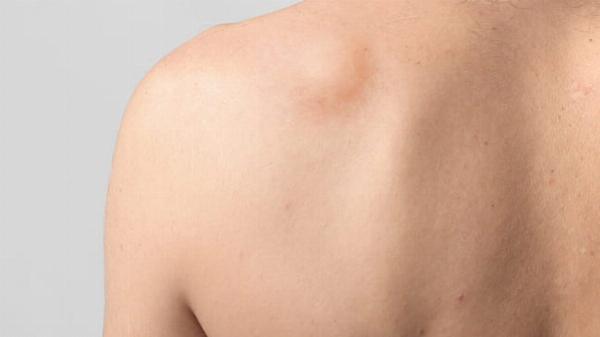 Lipoma Treatment: A Step-by-Step Guide