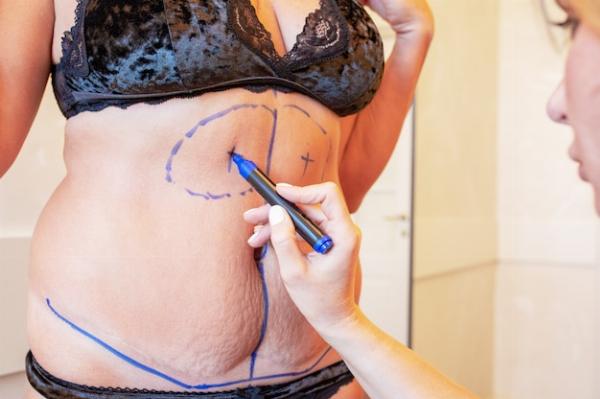 Liposuction Risks: A Complete Guide to make an informed decision