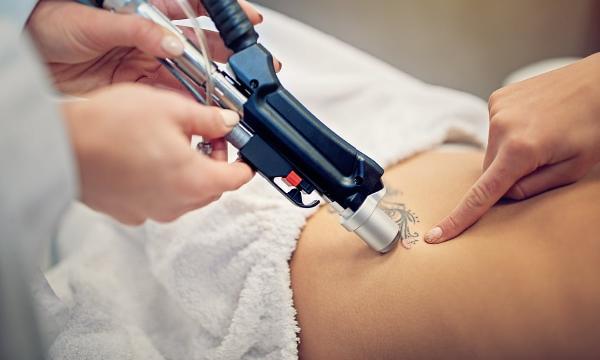 Discover the Secret to Effective Laser Tattoo Removal
