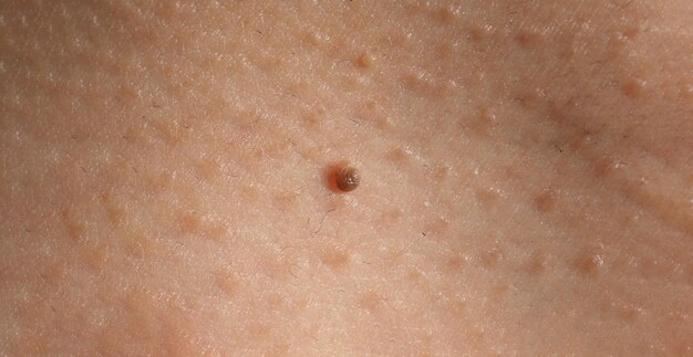 Skin Tag Removal 101: Easy Treatments You Need