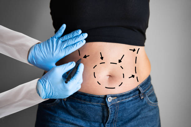 "Unlock a New You: A Comprehensive Look at Tummy Tuck Treatments"