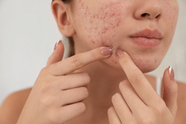 Acne-Prone Skin: Causes, Care Tips, and How to Manage It Effectively