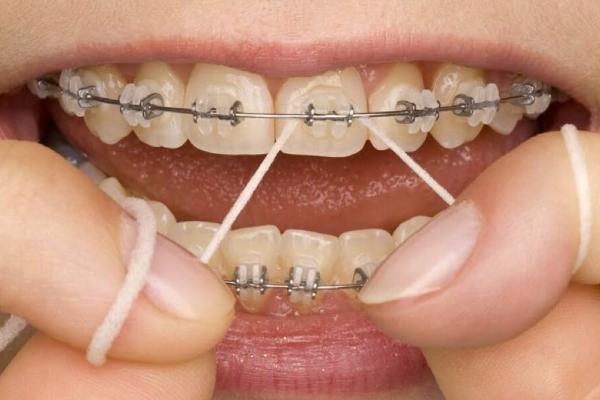 Damon Braces and Oral Hygiene: Essential Tips