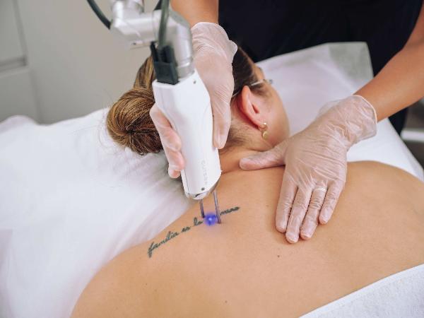 Laser Tattoo Removal: How to Prepare in Dubai