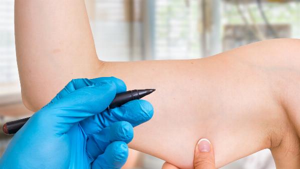 The Road to Beautiful Arms: How Arm Lift Surgery Can Help
