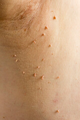 Skin Tag Removal: Transform Your Skin Today