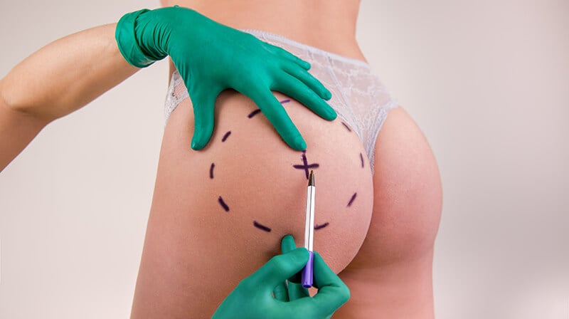 Buttock Augmentation: Your Complete Guide