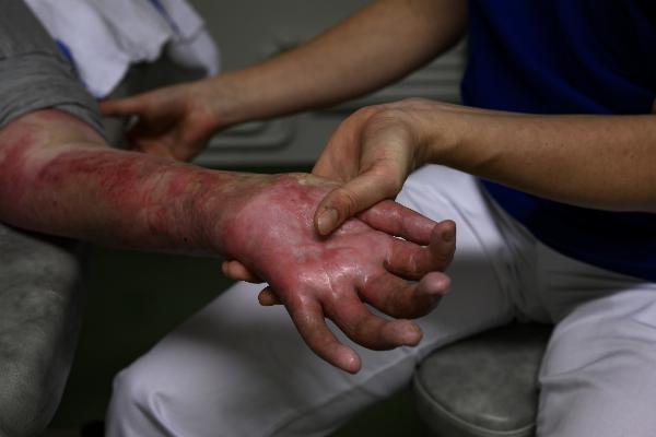From Burn to Beauty: How Reconstructive Surgery Changes Lives