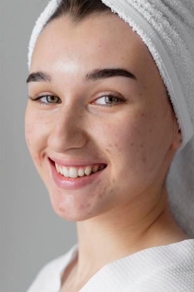 Simple Steps to Effective Melasma Treatment Success
