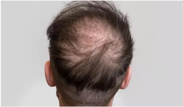 How to Treat Premature Baldness in Men