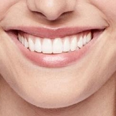 The Benefits of Early Intervention for Overlapping Teeth