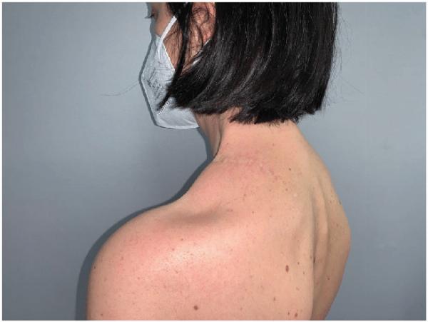Lipoma Treatment: Proven Techniques for Relief