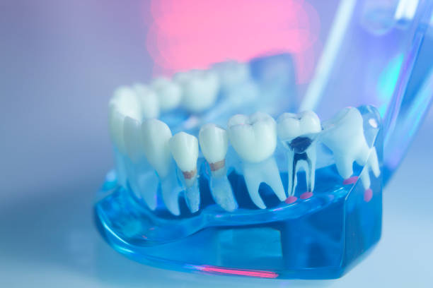 "Root Canal Rescue: The Key to Saving Your Tooth and Relieving Pain"