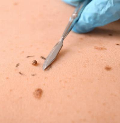 "Skin Tag Removal Treatment: Finding the Best Approach for Your Skin"