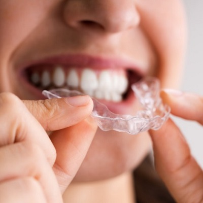 Exploring Cosmetic Dentistry Options for Overlapping Teeth