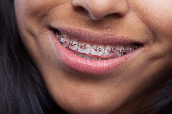 What Factors Increase the Cost of Dental Braces in Dubai