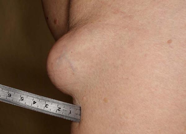 Top Lipoma Treatment Clinics: Where to Go for Care