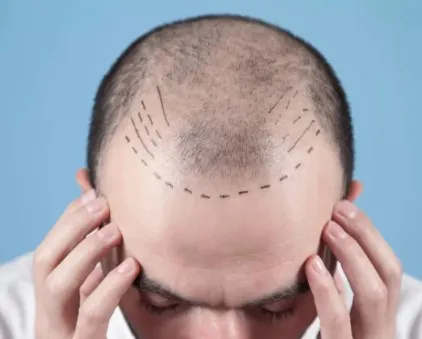 11 Tips to Cover and Treat Thinning Hair in Men
