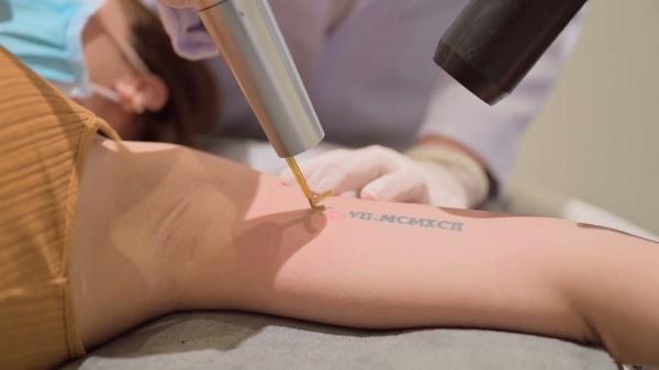 Fading Tattoos for Good with Laser Tattoo Removal
