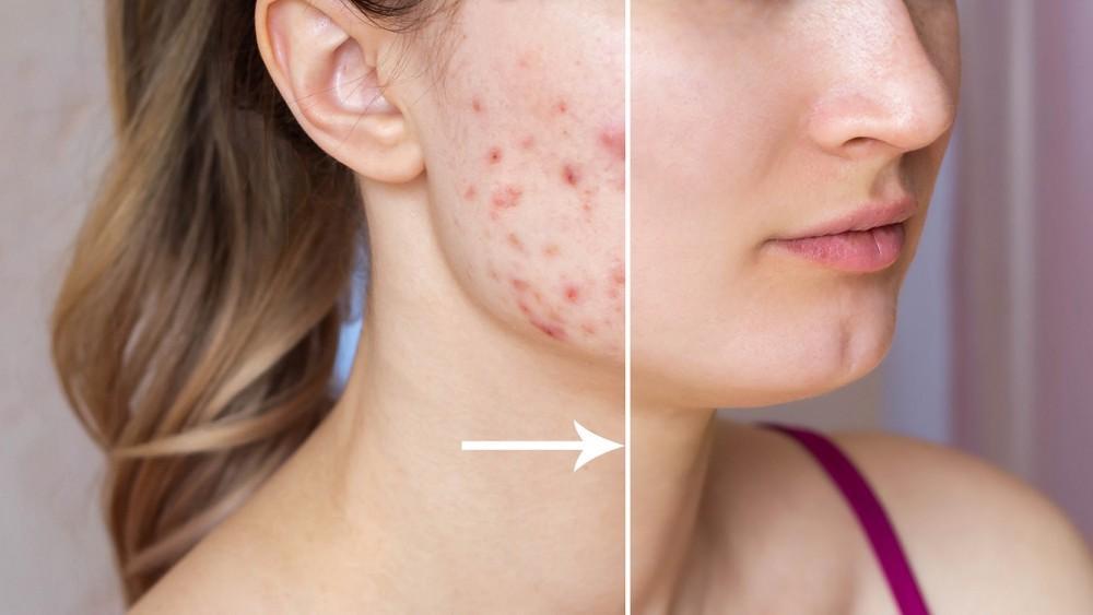 Laser Acne Treatment: Your Solution to Acne Scars