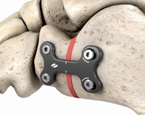 Osteotomy Plates Market Share, Growth Statistics, Trends Analysis, Forecast 2024-2032