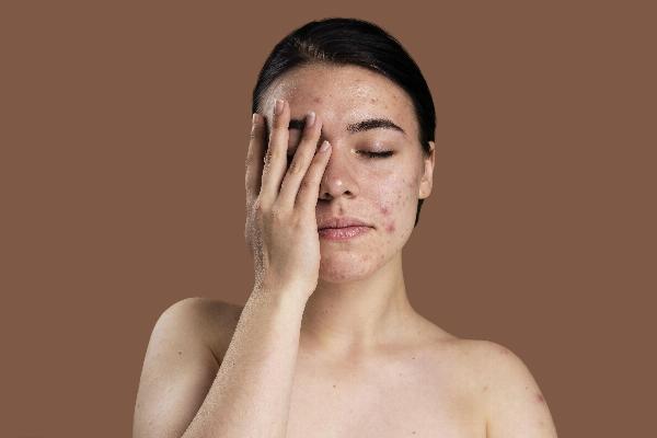 What Are the Stages of a Blind Pimple?