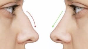Dubai’s Rhinoplasty Experts: Enhancing Natural Beauty