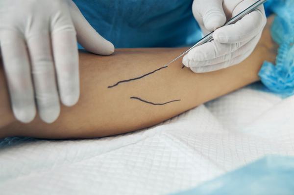 Beyond Treatment: Lifestyle Tips for Vascular Health