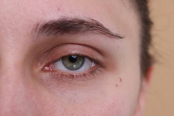 The Impact of Sleep on Eye Bags and Removal Techniques