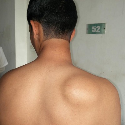 Effective Lipoma Treatment Strategies You Can Trust