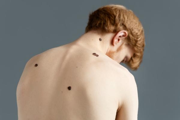 Quick Skin Tag Removal: Heal Your Skin Naturally