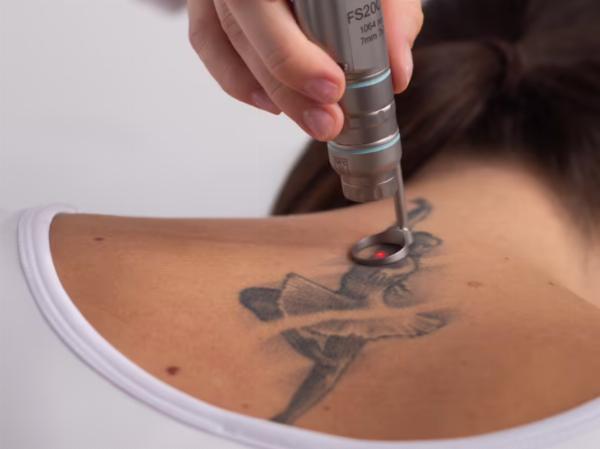 Laser Tattoo Evacuation Strategies: How It's Finished in Dubai