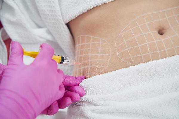Fat Transfer Surgery for Facial Rejuvenation: What to Expect