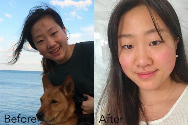 Is COSRX Good for Teenage Skin?