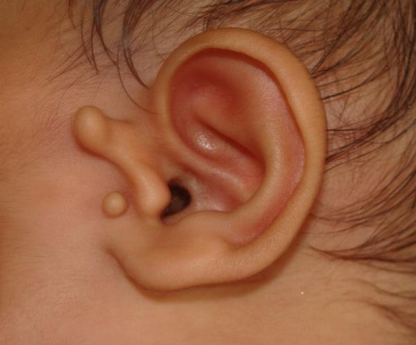 Preauricular Tag Removal: Restoring Facial Symmetry