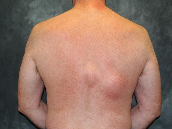 Lipoma Treatment Success Stories: Real-Life Experiences