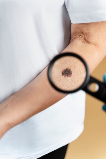 Skin Tag Removal: What Works Best for You?