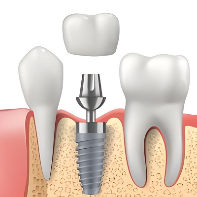 How Do Dental Implants Affect Speech and Eating?