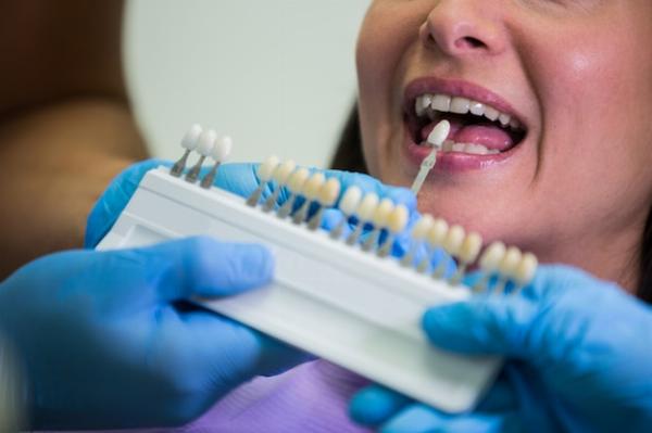 Composite Veneer Cost: Invest in Your Smile Wisely