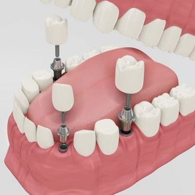 How Can You Determine If You're a Good Candidate for Implants?